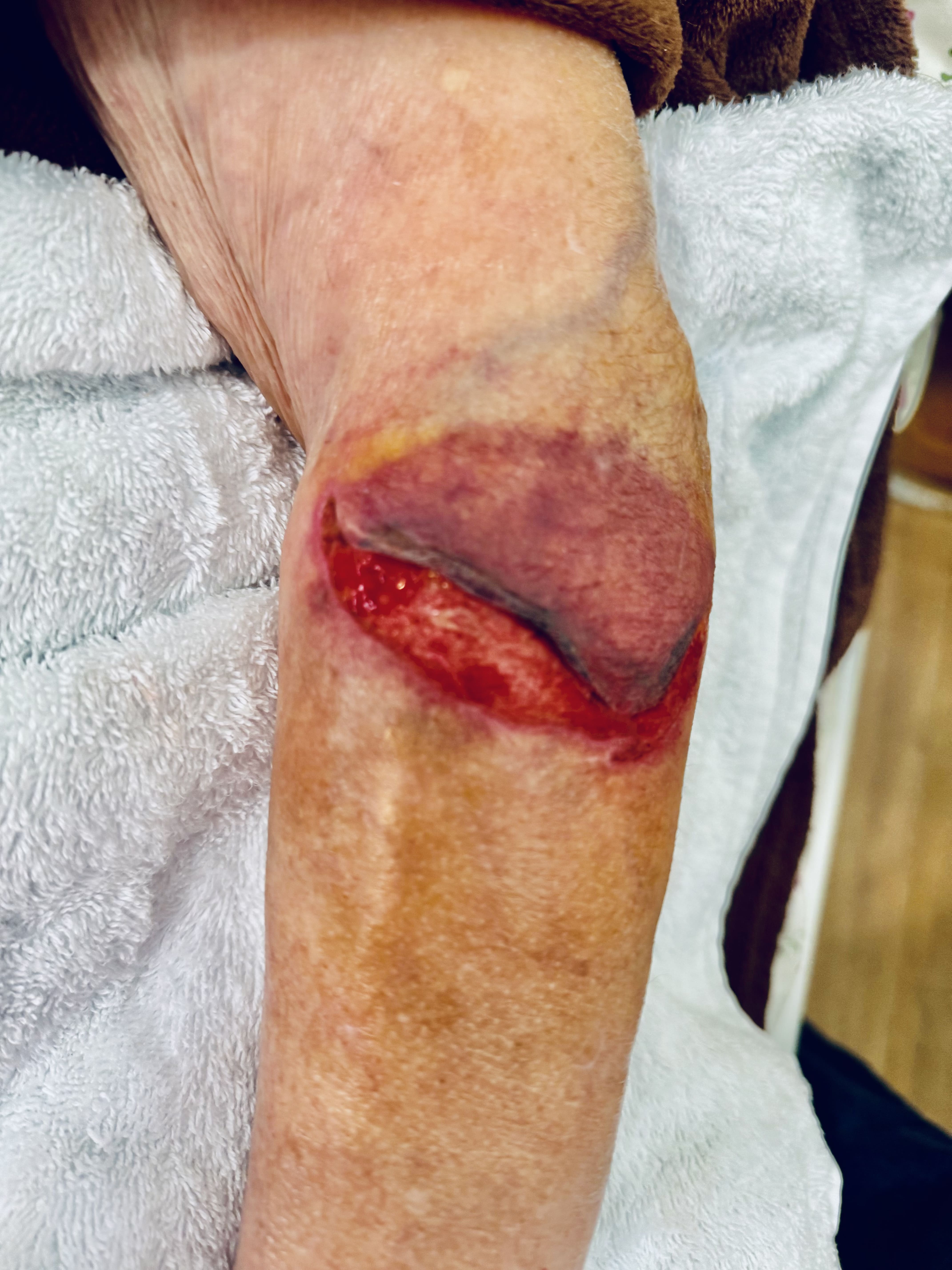 Foto antes do tratamento de Skin Tears