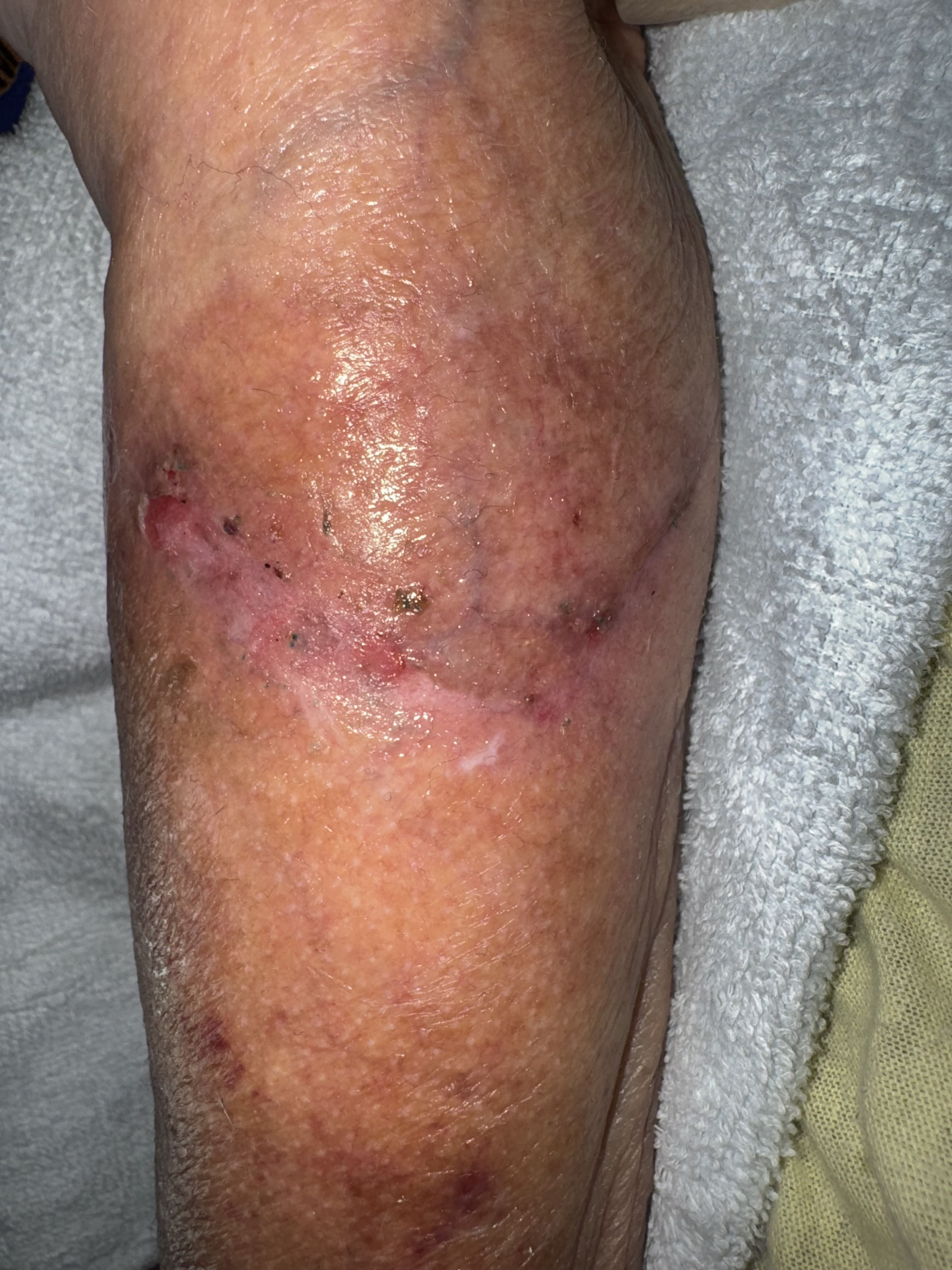 Foto depois do tratamento de Skin Tears