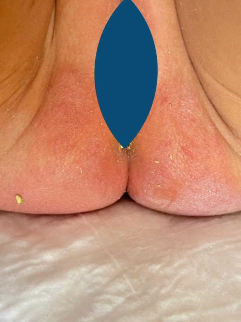 Foto antes do tratamento de Assadura