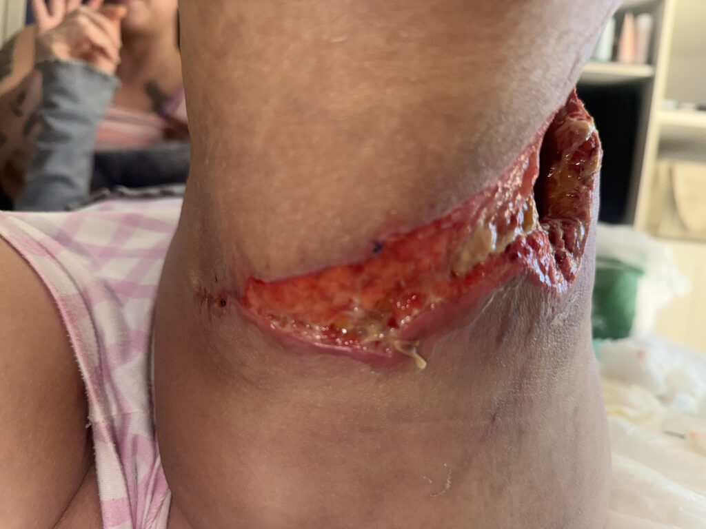 Foto antes do tratamento de Feridas Complexas