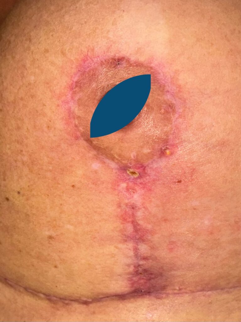 Foto depois do tratamento de Feridas Cirúrgicas