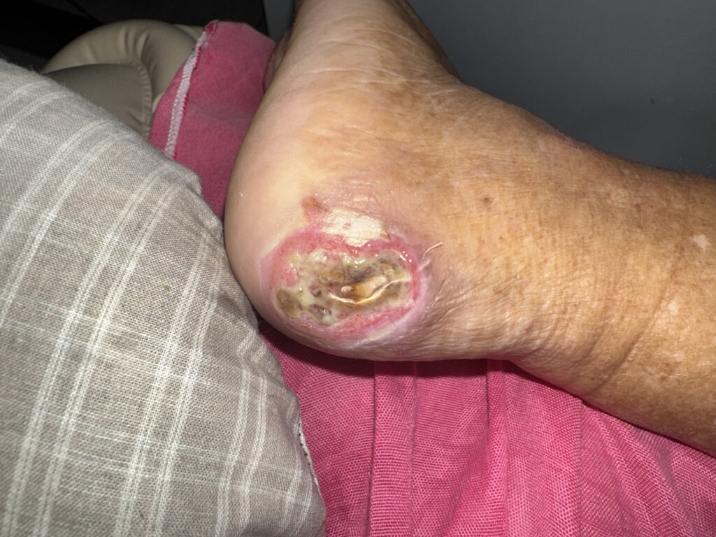 Foto antes do tratamento de Lesão por Pressão