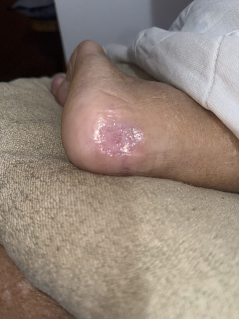 Foto depois do tratamento de Lesão por Pressão