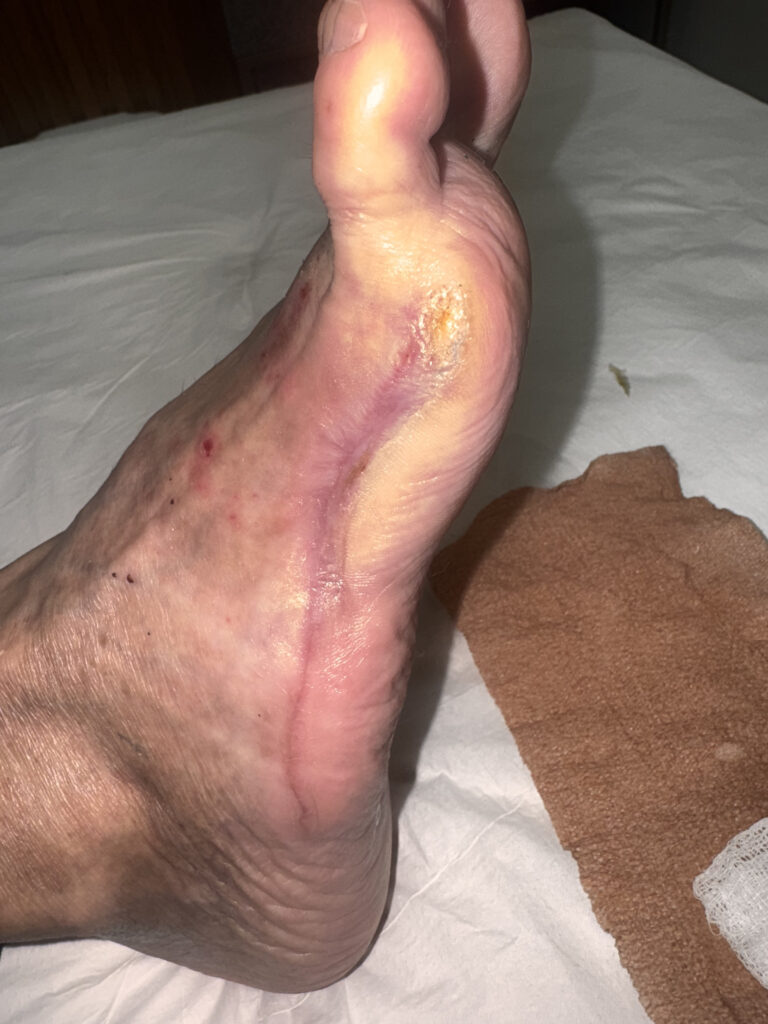 Foto depois do tratamento de Pé Diabético