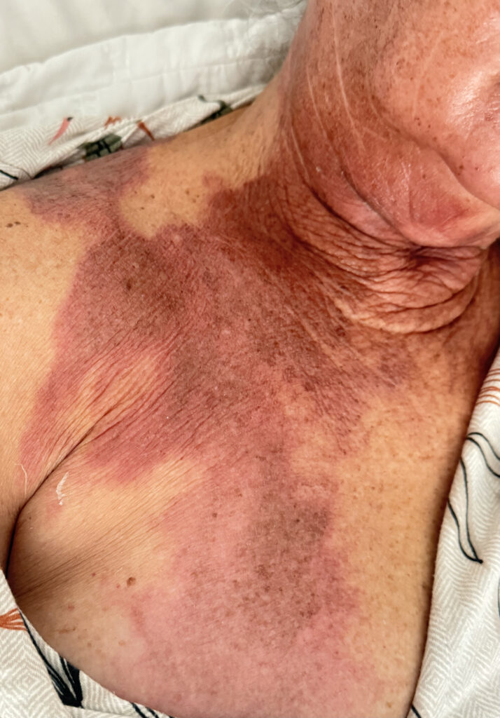 Foto antes do tratamento de Queimaduras