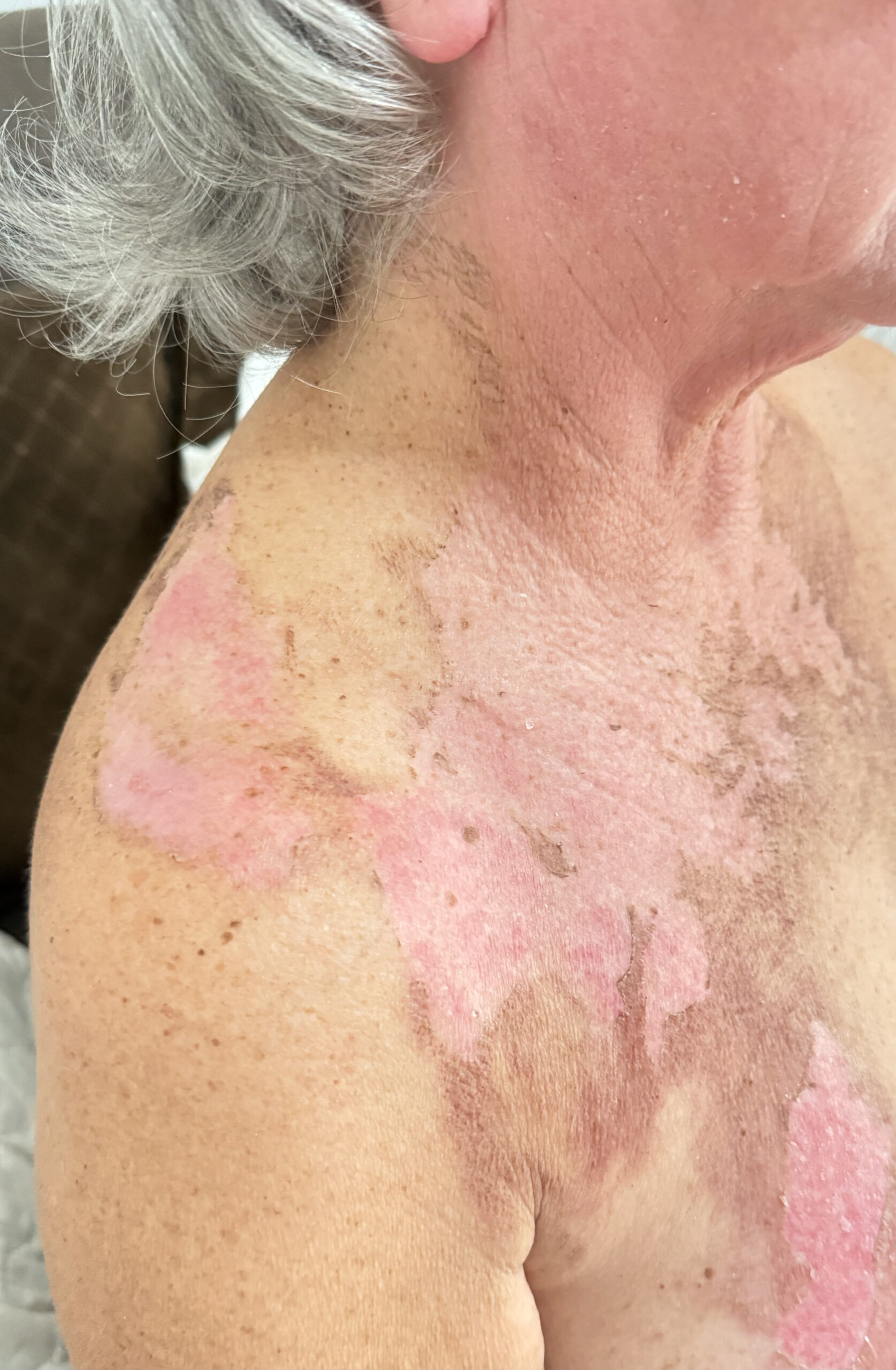 Foto depois do tratamento de Queimaduras