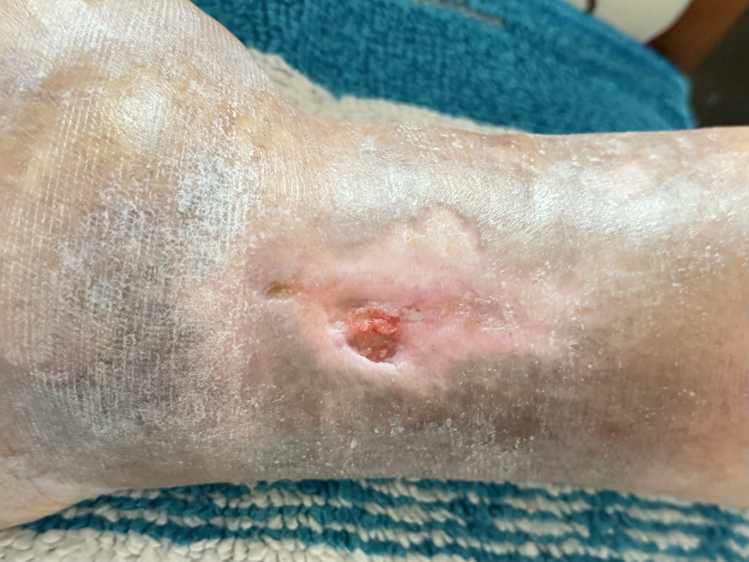 Foto depois do tratamento de Úlceras Venosas e Arteriais